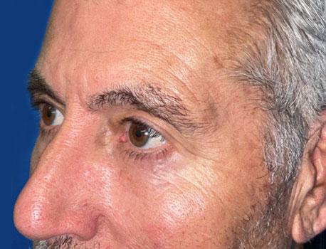 Blepharoplasty after at Leyngold Institute for Plastic Surgery in Meridian, ID
