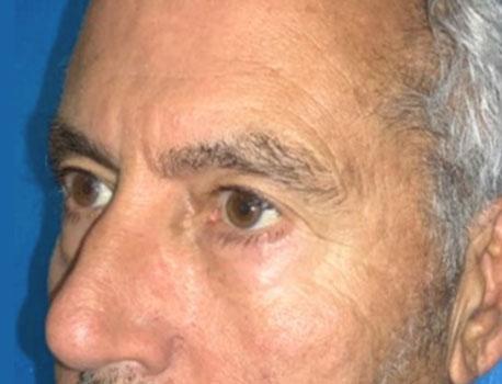 Blepharoplasty before at Leyngold Institute for Plastic Surgery in Meridian, ID