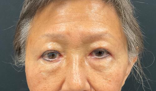 Blepharoplasty after at Leyngold Institute for Plastic Surgery in Meridian, ID