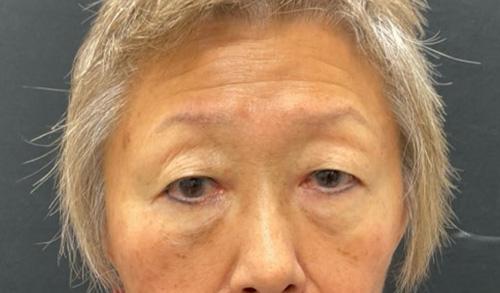 Blepharoplasty before at Leyngold Institute for Plastic Surgery in Meridian, ID