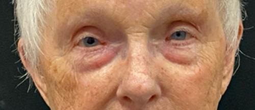 Blepharoplasty after at Leyngold Institute for Plastic Surgery in Meridian, ID