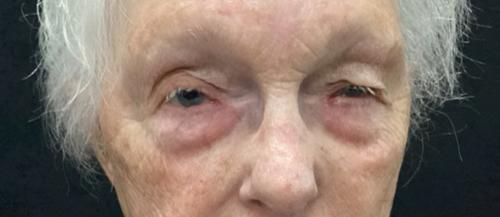 Blepharoplasty before at Leyngold Institute for Plastic Surgery in Meridian, ID