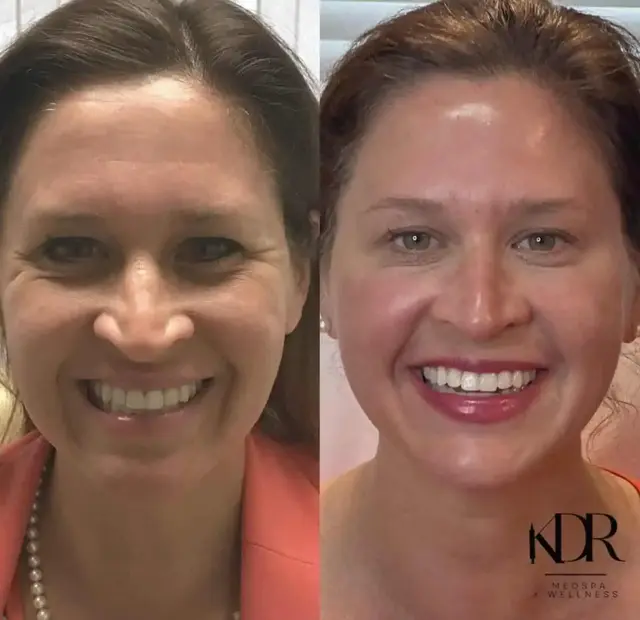 Botox result at KDR MedSpa + Wellness in Boston, MA