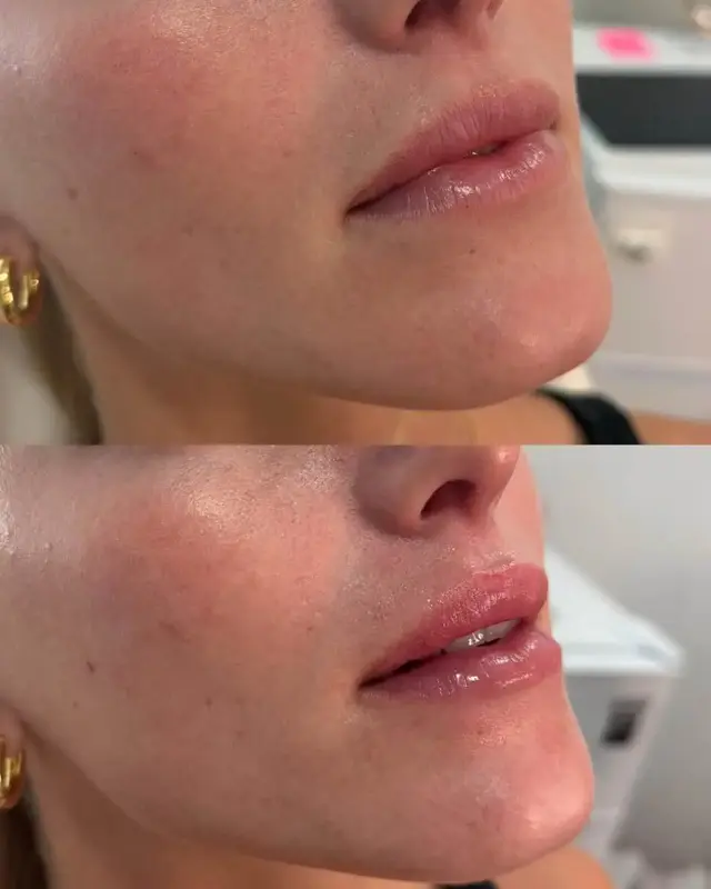 Lip Filler result at KDR MedSpa + Wellness in Boston, MA