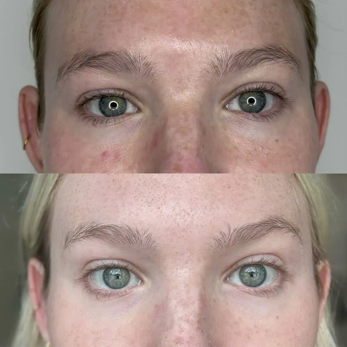 KDR MedSpa + Wellness botox result — Boston, MA
