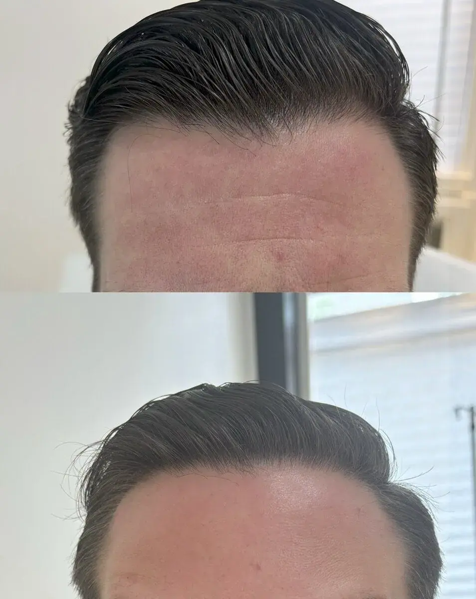 KDR MedSpa + Wellness botox result — Boston, MA