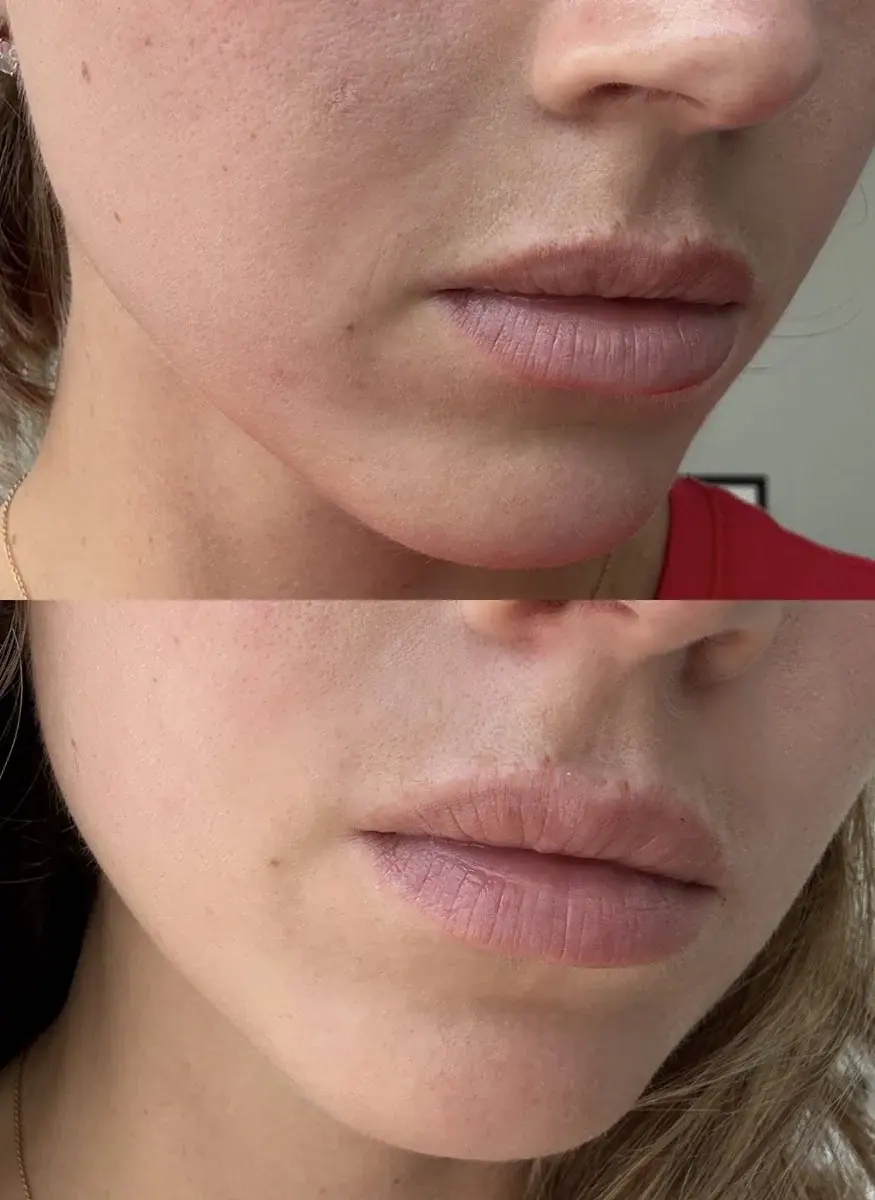 KDR MedSpa + Wellness lip filler result — Boston, MA