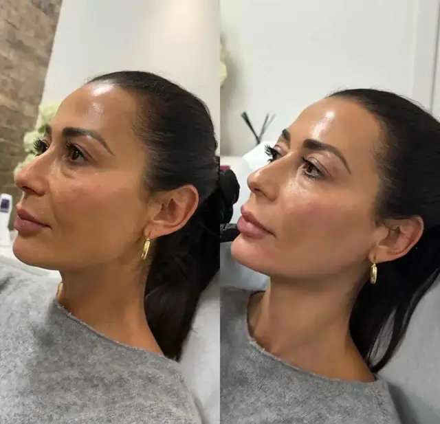 Dermal Fillers result at KDR MedSpa + Wellness in Boston, MA