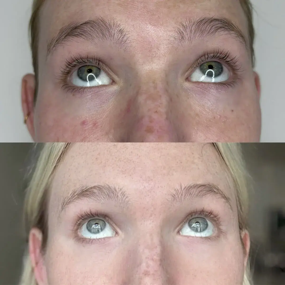 KDR MedSpa + Wellness botox result — Boston, MA