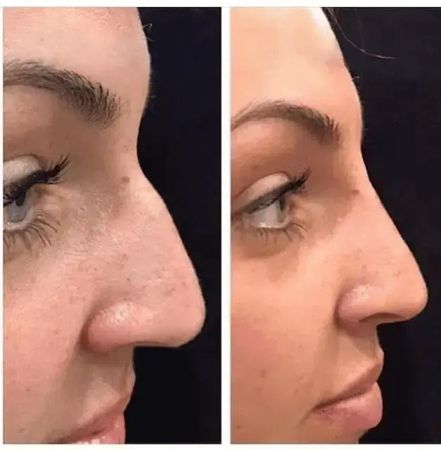 Rhinoplasty result at KDR MedSpa + Wellness in Boston, MA