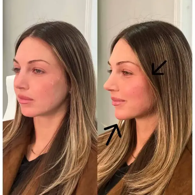 Dermal Fillers result at KDR MedSpa + Wellness in Boston, MA