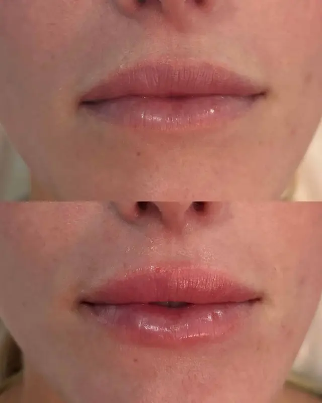 Jawline Filler result at KDR MedSpa + Wellness in Boston, MA
