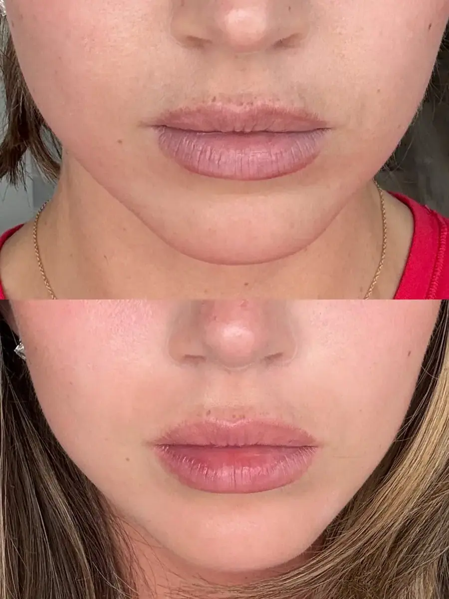 KDR MedSpa + Wellness lip filler result — Boston, MA