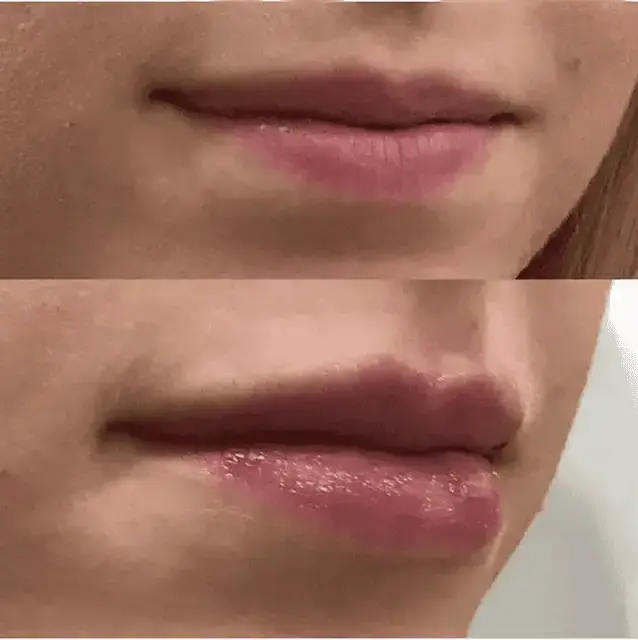 Juvederm result at KDR MedSpa + Wellness in Boston, MA