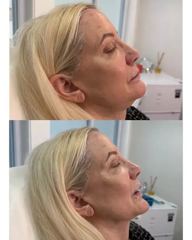 Juvederm result at KDR MedSpa + Wellness in Boston, MA