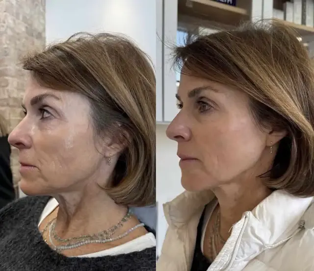 Deep Plane Facelift result at KDR MedSpa + Wellness in Boston, MA