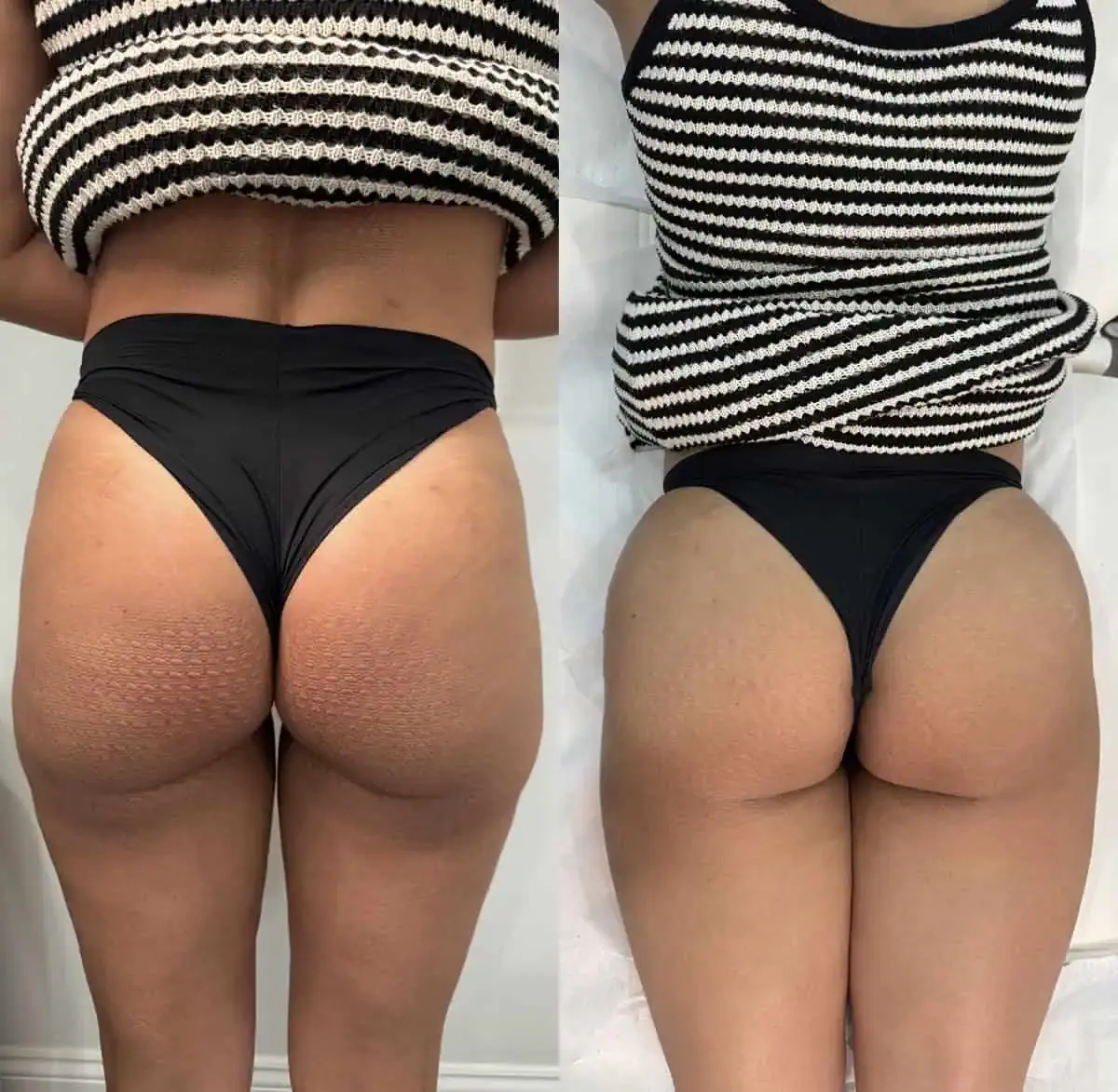 KDR MedSpa + Wellness lip filler result — Boston, MA