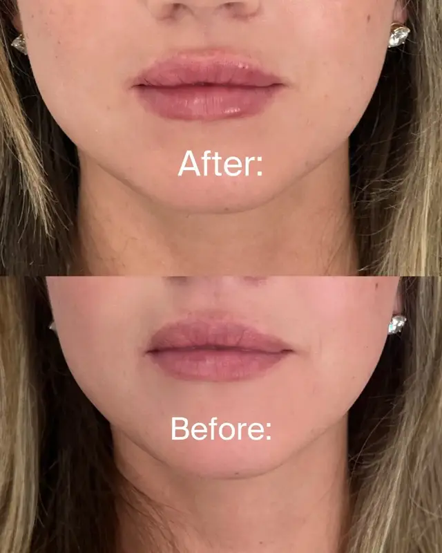Juvederm result at KDR MedSpa + Wellness in Boston, MA