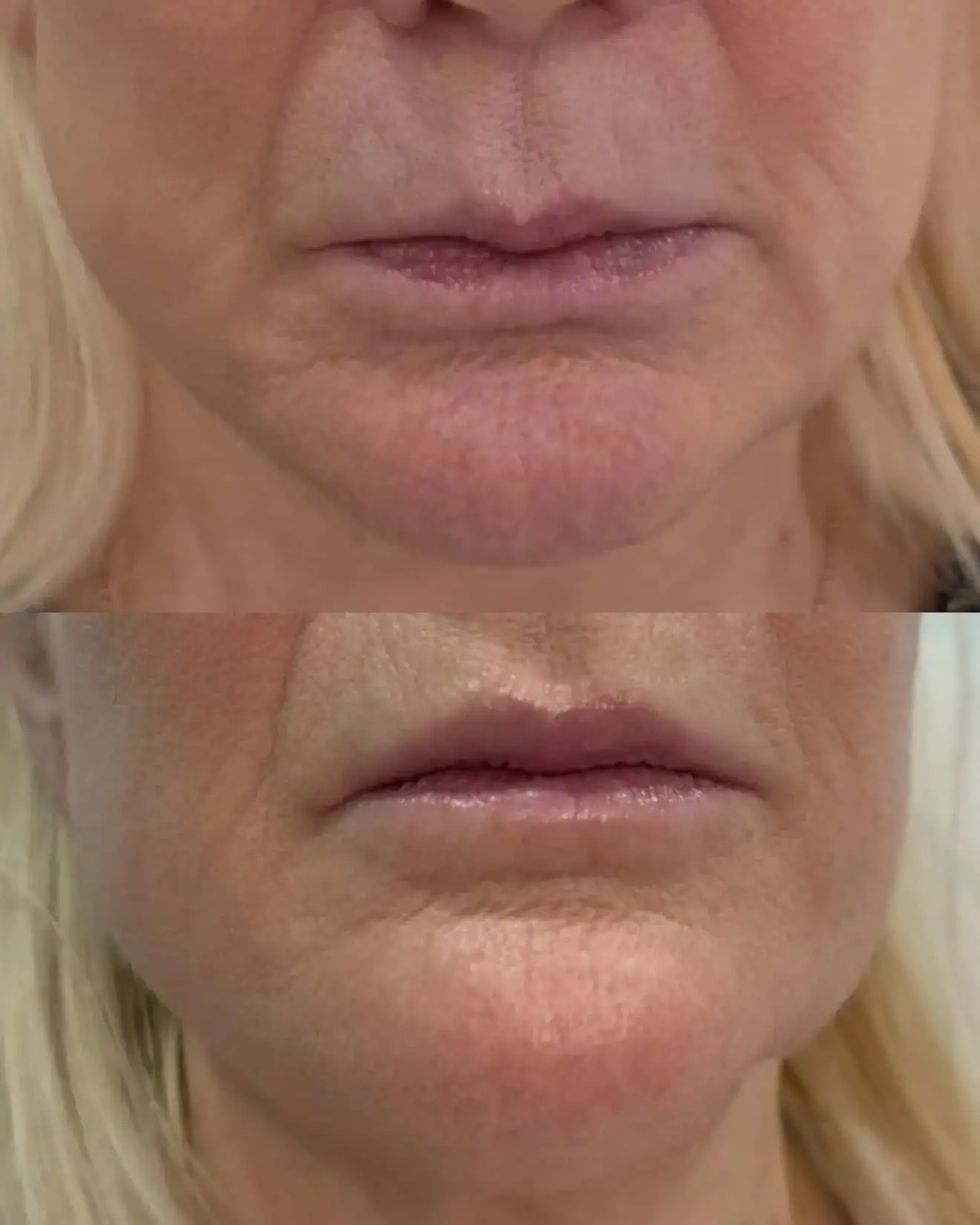 KDR MedSpa + Wellness lip filler result — Boston, MA