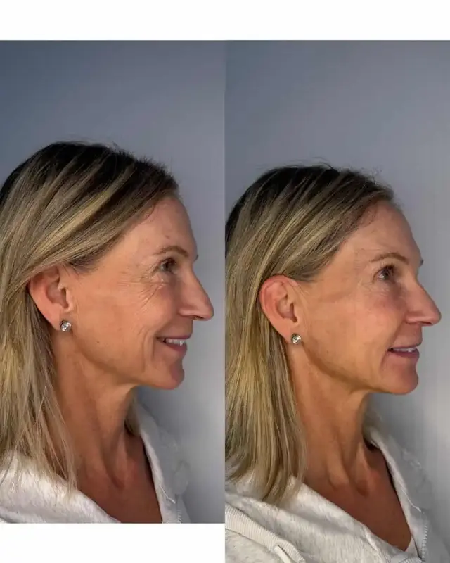 Botox result at KDR MedSpa + Wellness in Boston, MA