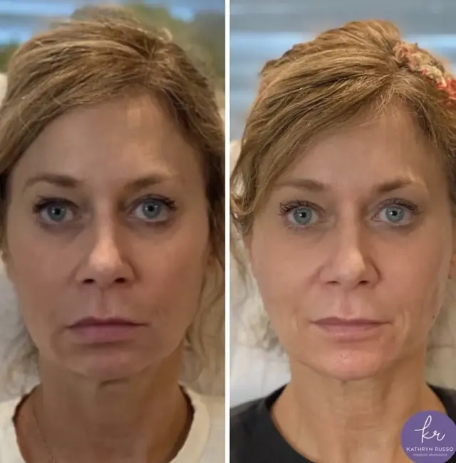 Juvederm result at KDR MedSpa + Wellness in Boston, MA