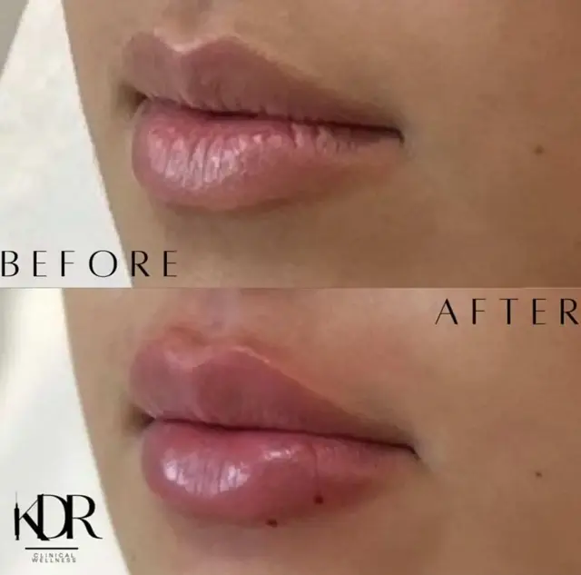 Juvederm result at KDR MedSpa + Wellness in Boston, MA