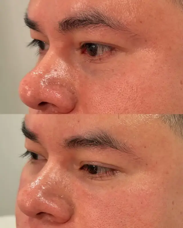 Rhinoplasty result at KDR MedSpa + Wellness in Boston, MA