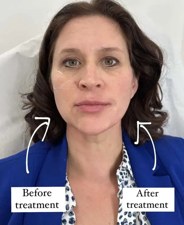 Juvederm result at KDR MedSpa + Wellness in Boston, MA