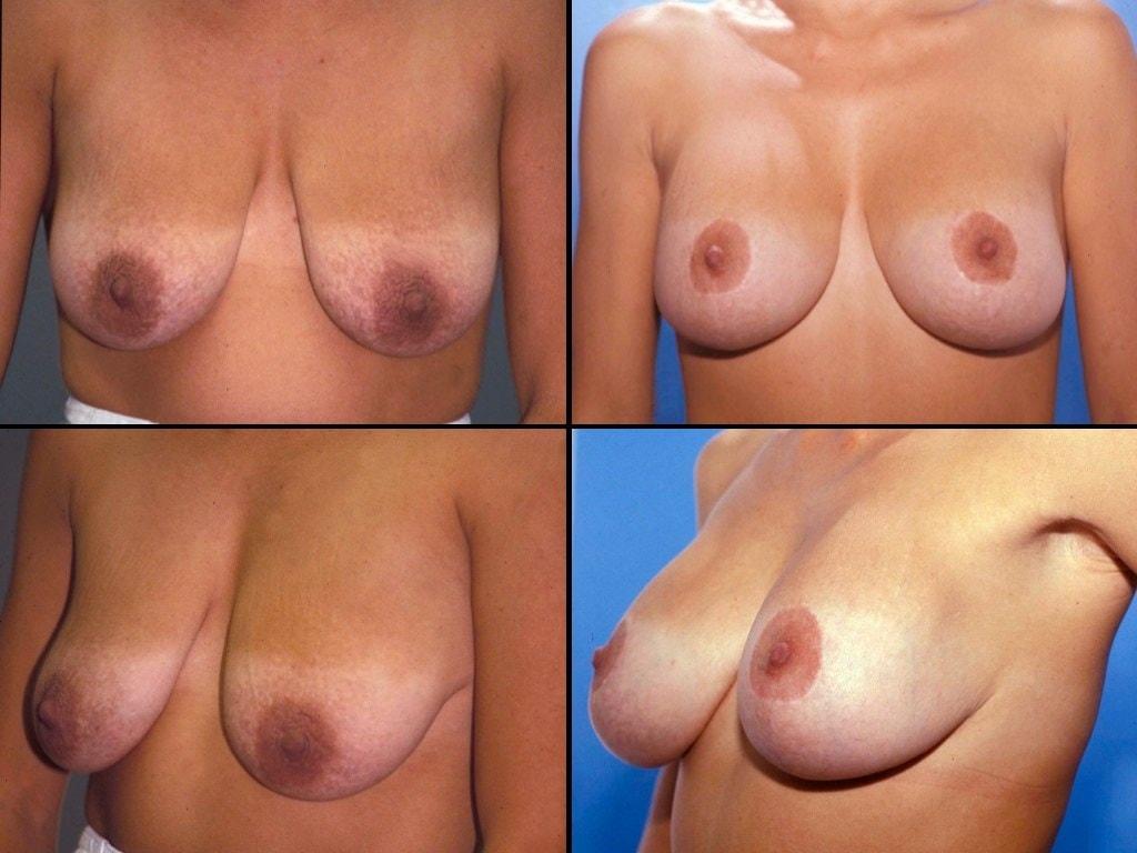 Neal Handel, MD breast lift result — Beverly Hills, CA
