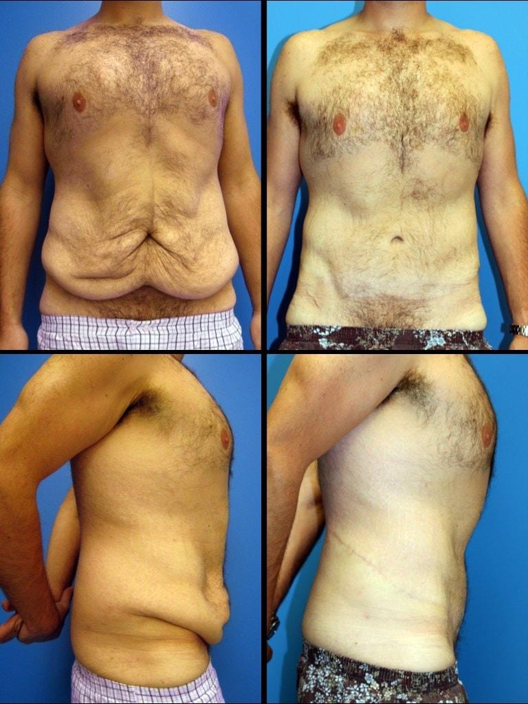 Neal Handel, MD tummy tuck result — Beverly Hills, CA