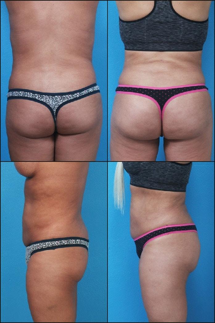Neal Handel, MD bbl result — Beverly Hills, CA
