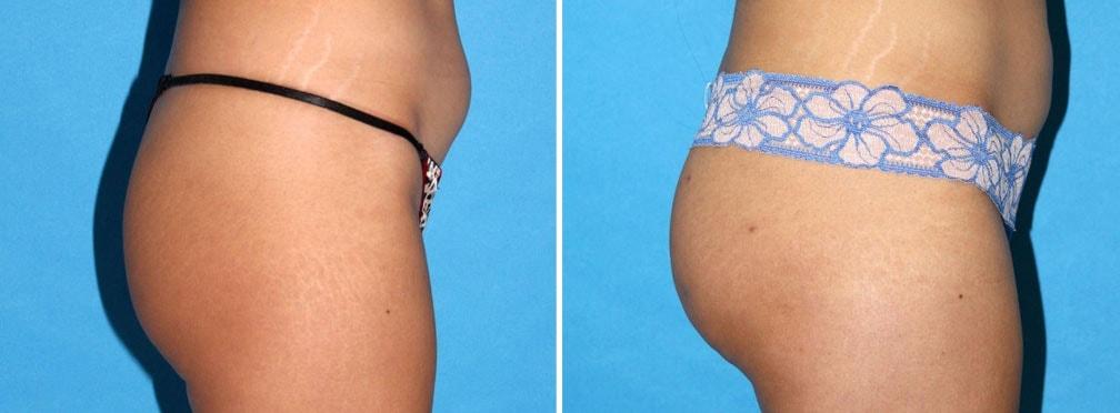 Neal Handel, MD bbl result — Beverly Hills, CA