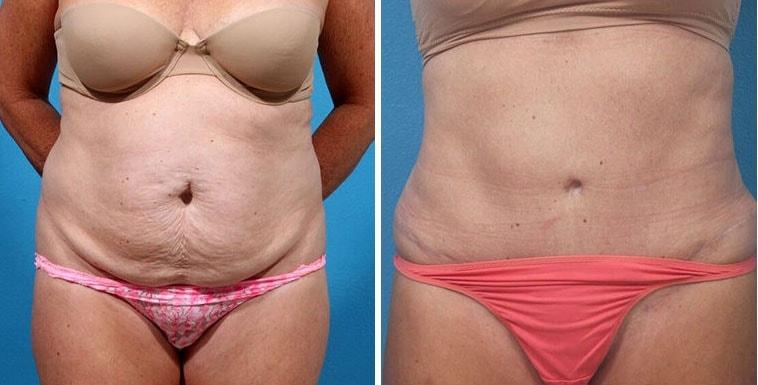 Neal Handel, MD tummy tuck result — Beverly Hills, CA