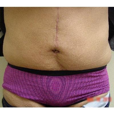 Tummy Tuck after at Del Mar Plastic Surgery in San Diego, CA