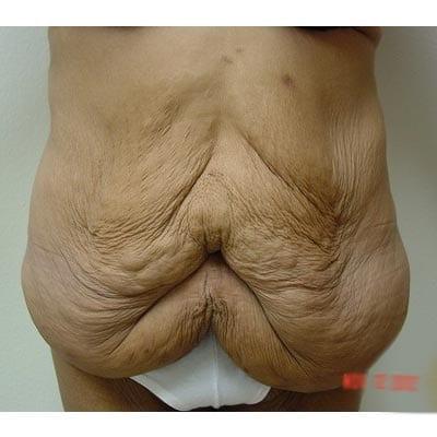 Tummy Tuck before at Del Mar Plastic Surgery in San Diego, CA