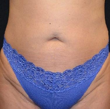 Del Mar Plastic Surgery liposuction after — San Diego, CA