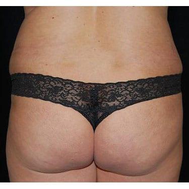 Liposuction after at Del Mar Plastic Surgery in San Diego, CA