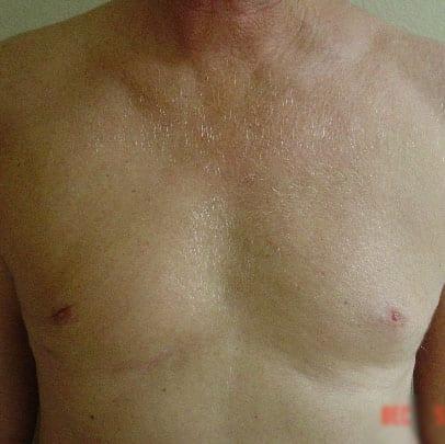 Liposuction after at Del Mar Plastic Surgery in San Diego, CA