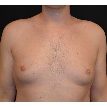 Liposuction before at Del Mar Plastic Surgery in San Diego, CA