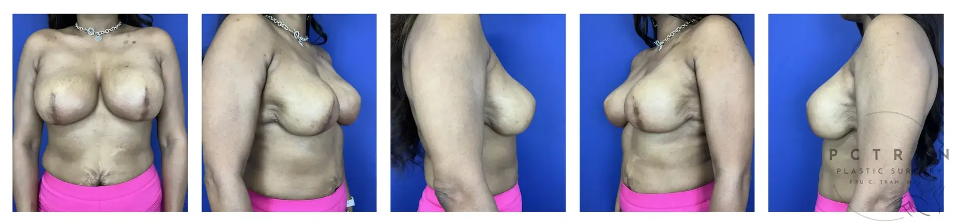 Phu C. Tran, MD Plastic Surgery after — Fresno, CA