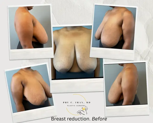 Breast Reduction before at Phu C. Tran, MD Plastic Surgery in Fresno, CA