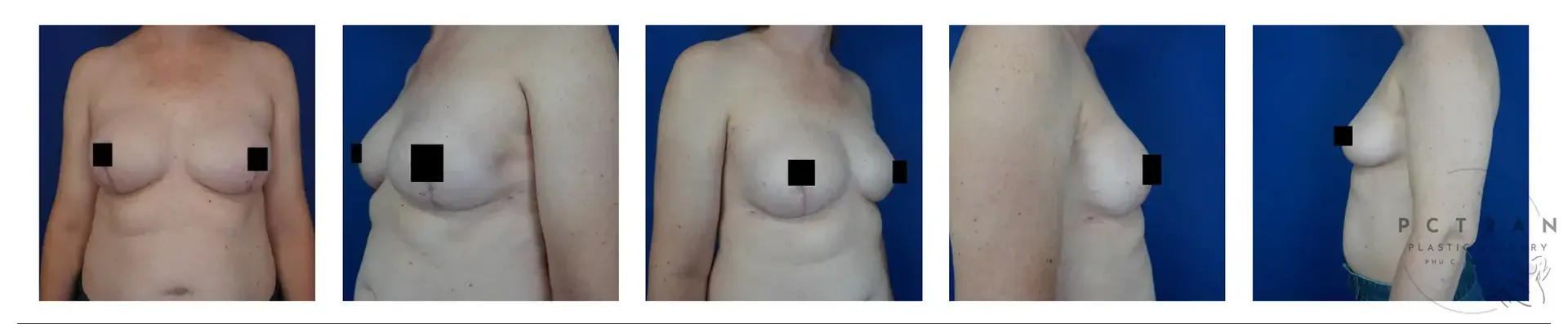 Phu C. Tran, MD Plastic Surgery after — Fresno, CA