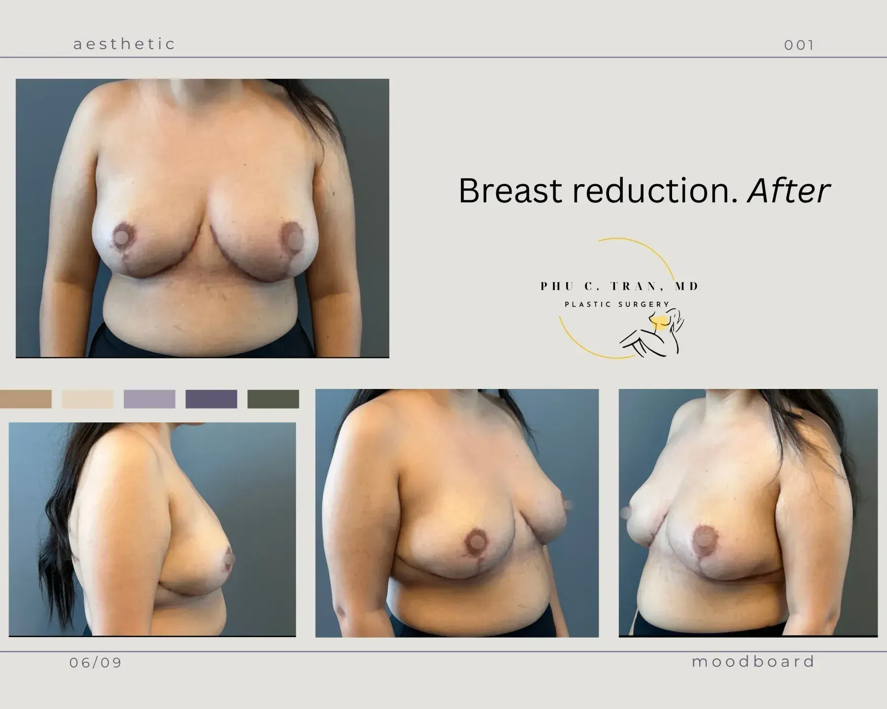 Phu C. Tran, MD Plastic Surgery breast reduction after — Fresno, CA