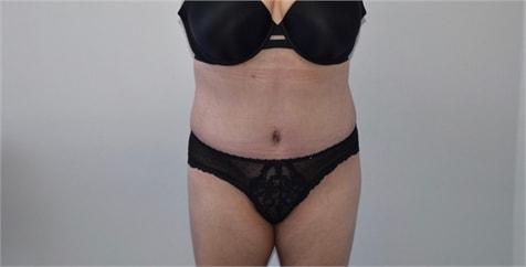 Elliot M. Hirsch, MD tummy tuck after — Los Angeles, CA
