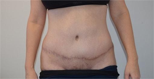 Elliot M. Hirsch, MD tummy tuck after — Los Angeles, CA