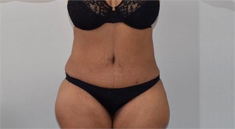 Elliot M. Hirsch, MD tummy tuck after — Los Angeles, CA