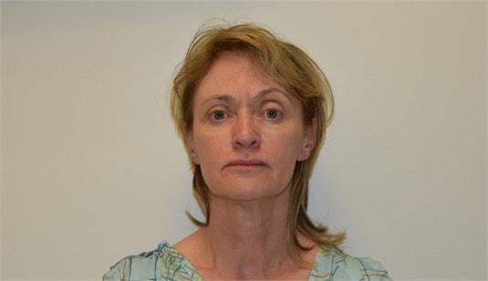 Facelift before at Elliot M. Hirsch, MD in Los Angeles, CA