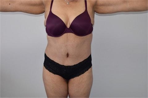 Elliot M. Hirsch, MD tummy tuck after — Los Angeles, CA