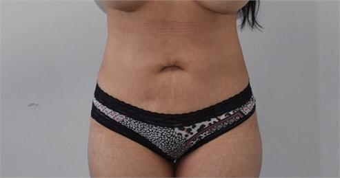 Elliot M. Hirsch, MD liposuction after — Los Angeles, CA