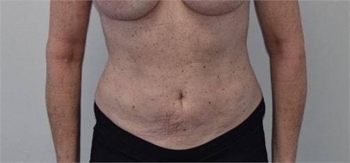 Elliot M. Hirsch, MD liposuction after — Los Angeles, CA